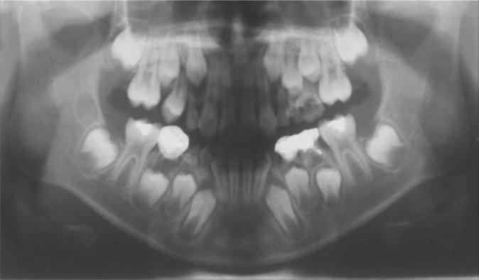 파노라마와치근단사진에서상악제1, 2 유구치의우식이관찰되며제2유구치는우식이이미치근분지부까지침범한것을알수있다 (Fig. 2). 상악의교합방사선사진에서구개골의병적인골변화는관찰되지않아서 (Fig.