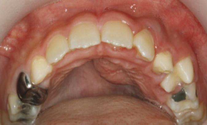 대한소아치과학회지 38(4) 2011 Fig. 4. 2 weeks after extraction of the maxillary left 2nd primary molar.