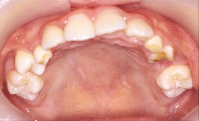 Fig. 5. Initial intraoral photograph showing the swelling of buccal gingiva and left hard palate. Fig. 7.