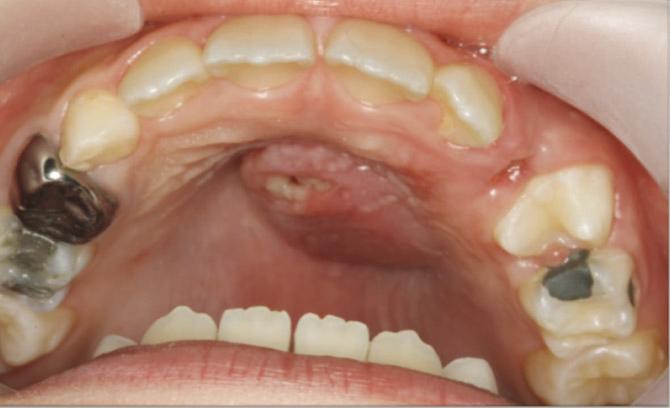 J Korean Acad Pediatr Dent 38(4) 2011 Fig. 8. 1 week after incision and drainage. The size of palatal swelling had decreased. Fig. 9.