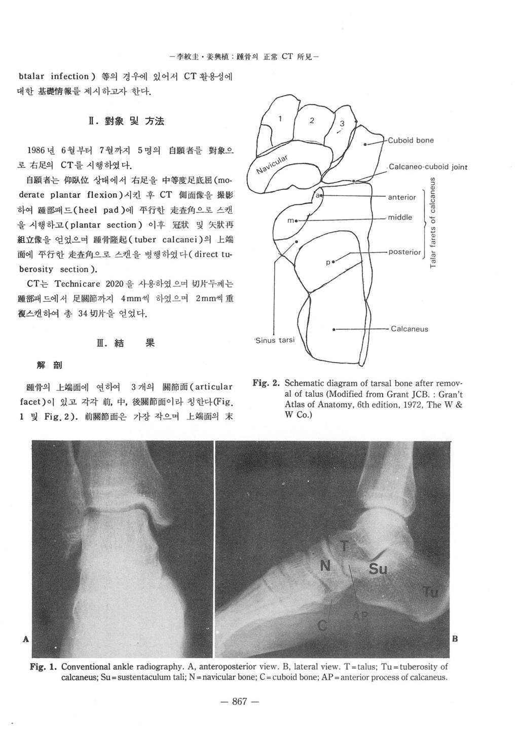 btalar infection) 等의경우에있어서 CT 활용갱에 대한基휩흉情報를제시하그 L 자한다. 1986 년 6 월부터 7 월까지 로右足의 CT 플시행하였다.