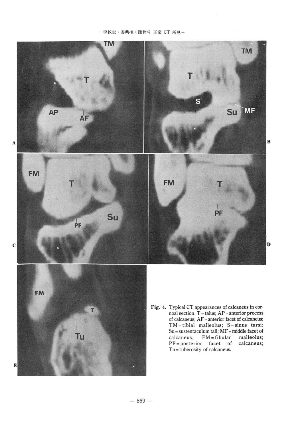 李救圭 姜興植 K 훨骨의正常 CT 所見 - A C D Fig. 4. Typical CT appearances of calcaneus in cornoal section.
