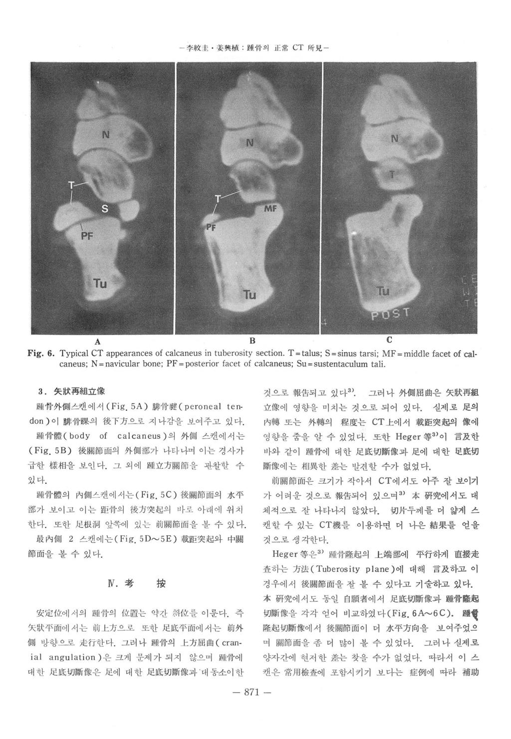 - 주救초 쫓興뼈 K 명 fi 의 ie 힘 CT JiJj- 見 - A C Fig. 6. Typical CT appearances of cajcaneus in tuberosity section.