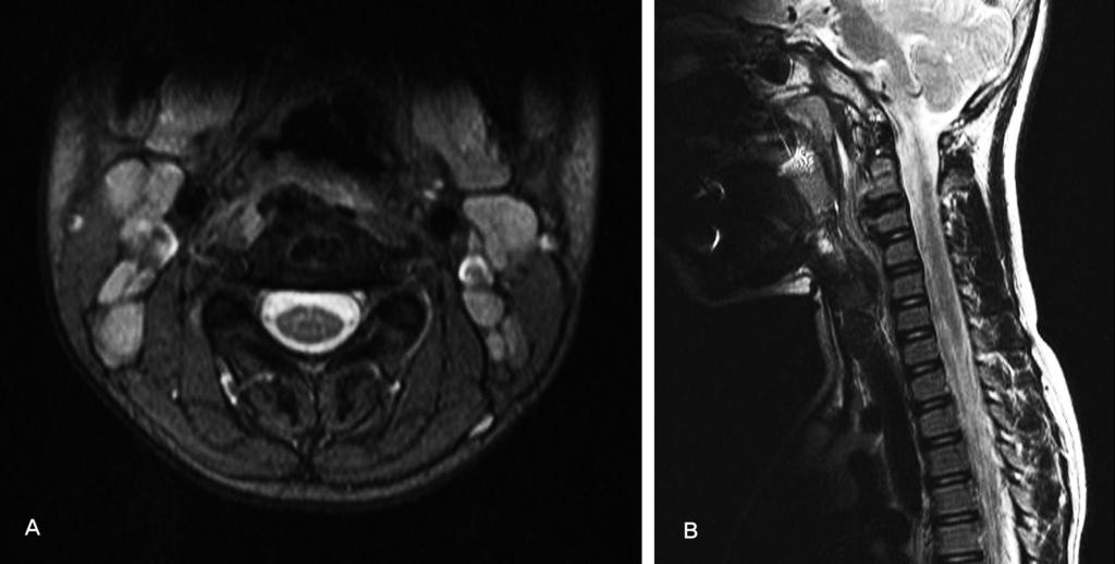 retropharyngeal widening (A) AP view (B) Lateral view Fig. 2. Initial MRI.