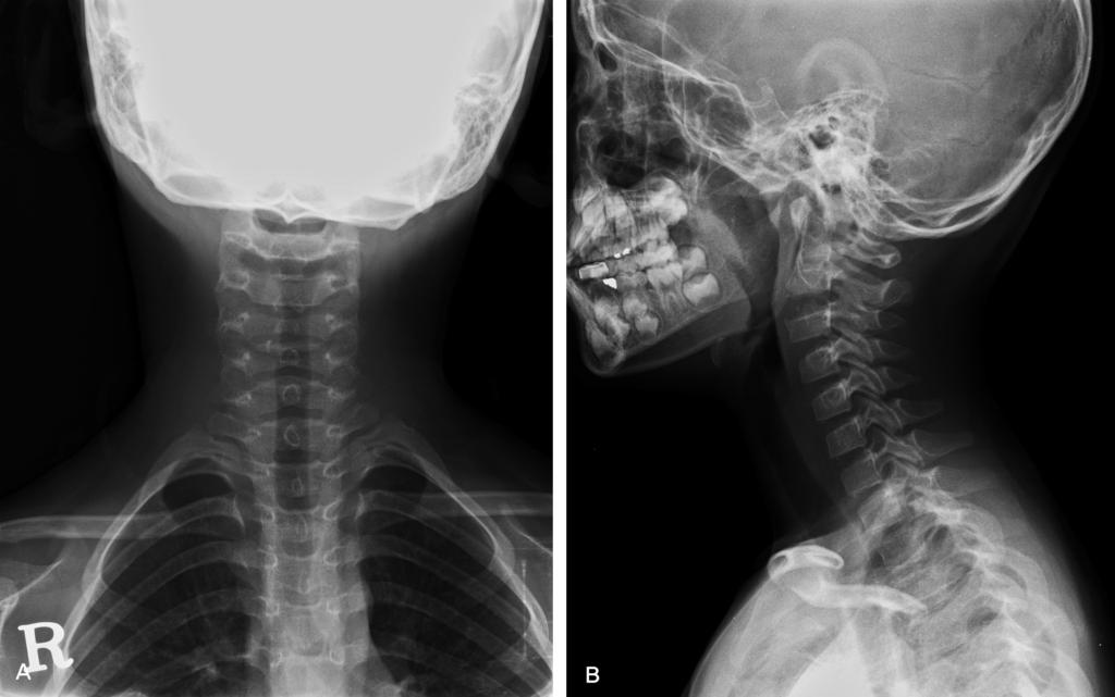 Journal of Korean Society of Spine Surgery Cervical Intervertebral Disc Calcification Fig. 4. F/U X-ray after 2 months.