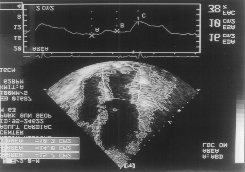 면 좌심방 용적이 거의 연속적으로 감소하여 수동적 ABD 시스템에서는 심초음파도 화면 영상의 질, 초 수축과 능동적 수축에 의한 용적 감소를 구별할 수 없 음파와 평행하게 놓였을 때 심내막의 영상이 감소되 는 경우가 있다6). 거나 소실되는 측벽의 echo drop out18), gain 조절에 A B Fig. 11.
