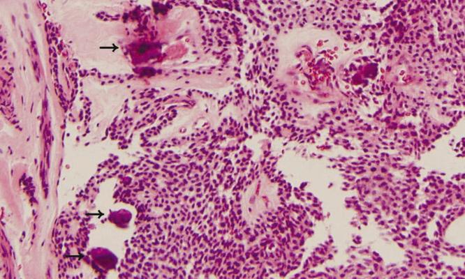 선양 치성 종양의 조직학적 특징은 섬유성 결합조직 피막이 상피세포의 결절을 둘러싸는 형태를 취하여 장미꽃송이 모양을 이루며 치성 상피는 도관 구조물을 형성한다14).