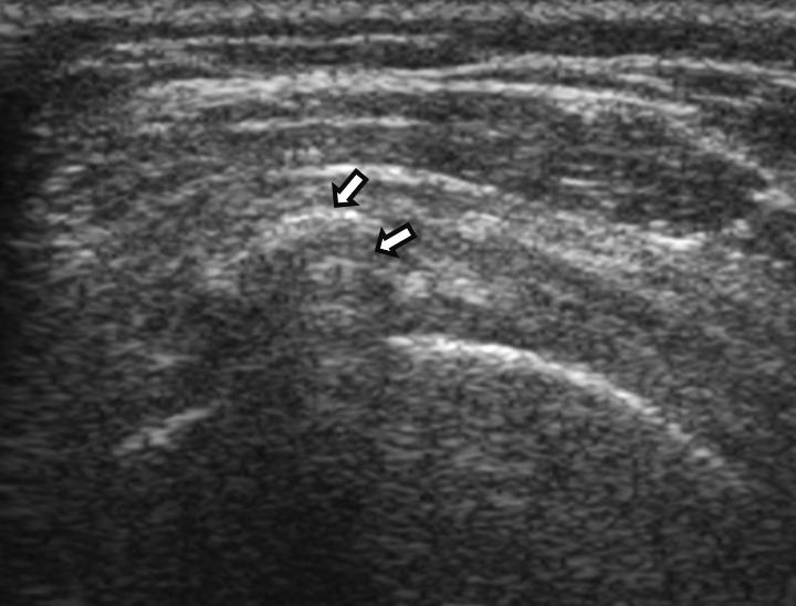 (A) For examination of the bicep tendon, the patient should hold their arm in a slight internal rotation with the elbow flexed at 90, palms up.