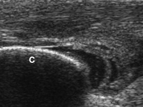 (B) Evidence of hypoechoic fluid collection in the retrocalcaneal area is indicative of retrocalcaneal bursitis.