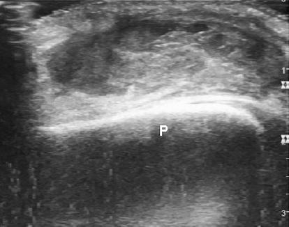 (C) In a longitudinal scan of a patellar lesion, we see a distended prepatellar bursa with hypoechic fluid.