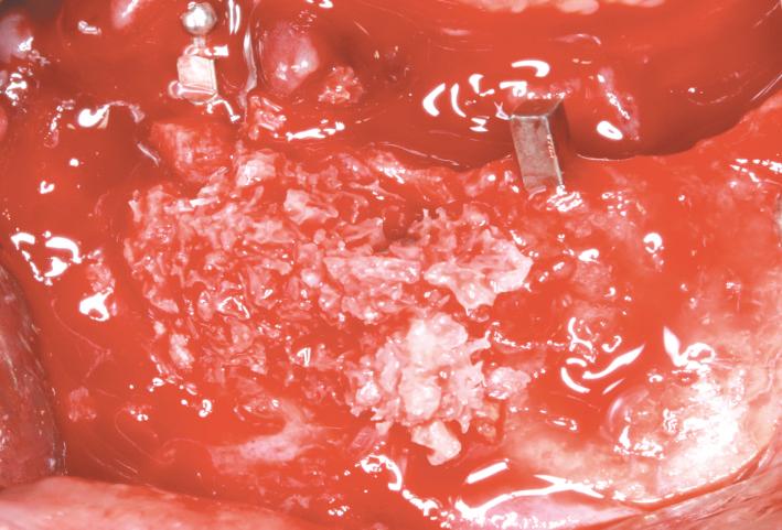 A B Fig. 2. Mineral allograft was grafted in the bone defect and collagen membrane was covered over the bone. Fig. 3.