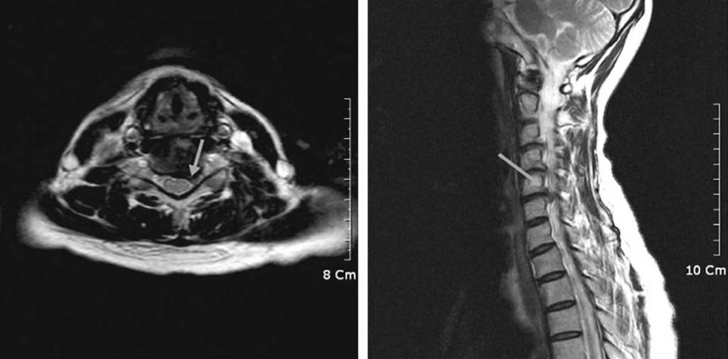 경추신경근병증환자에서최소침습적후방추간공절개술의조기수술결과 권영준 Fig. 1. Imaging studies obtained in a 52-year-old woman (Case 2) who presented with severe neck and radicular pain on left upper extremity.