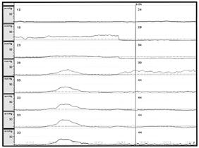- 나승연외 6 인 : 유방암근치적치료후발생한근염 - Figure 3. Electromyography. Positive sharp waves on left tibialis anterior muscle were as observed. Figure 4. Esophageal Manometry.