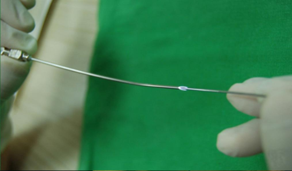 그러나 Wright needle은애초에근막을끼워서사용하게끔고안된바늘이므로, 실리콘줄에비해바늘이두꺼워필요이상의큰절개창이필요하며, 바늘이통과하면서불필요한조직손상을유발할수있다. 2-5 본연구에서는각막보호기능이저하된눈꺼풀처짐환 A 자에서시행한이마근걸이술에서실리콘줄의삽입가이드기구로서 17게이지척수마취용바늘의이용을소개하고수술결과를살펴보고자한다.