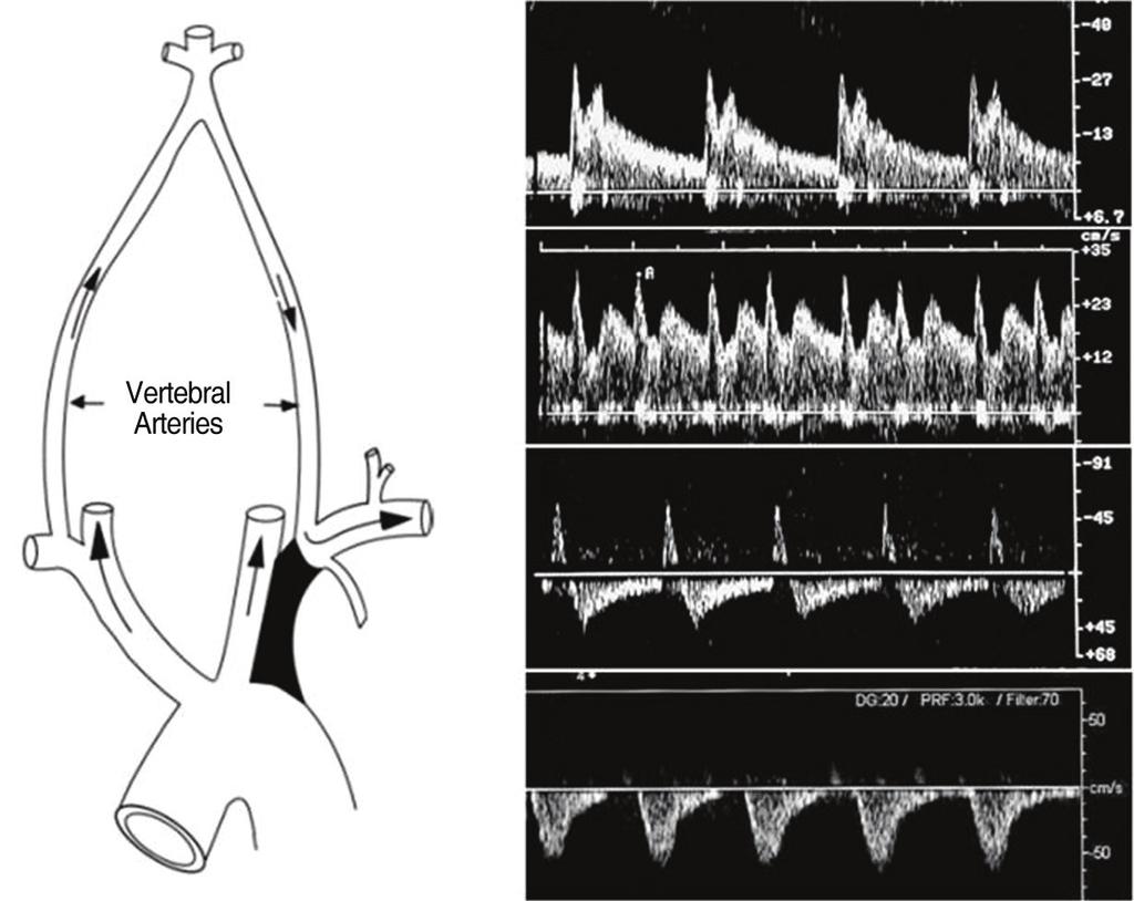 이종윤 척추기저동맥체의 duplex 초음파검사 A B C D E Fig. 5. Schematic representation of subclavian steal syndrome (A) and flow pattern (B-E). B. A pre-bunny vertebral artery (VA) Doppler waveform.