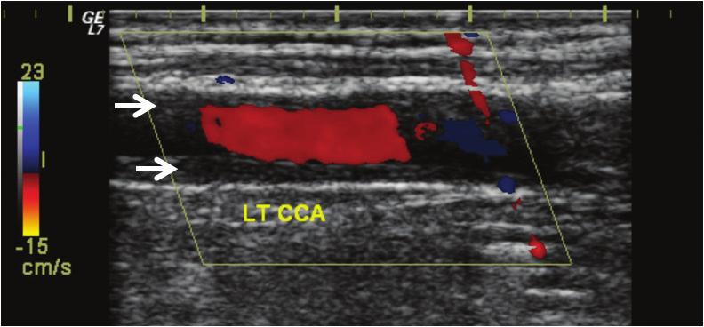 Vol. 10 / No. 2 / December 2018 Journal of Neurosonology and Neuroimaging (intimal flap) 이보이면확진가능하다. 71 1) 내경동맥박리 뇌경색을동반하는박리의경동맥초음파민감도는 91-100% 이다. 73,74 반면, 뇌경색을동반하지않는박리의초음파 민감도는 70% 이다.