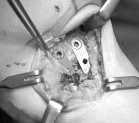 Aescula R 금속판을이용한경골근위부개방형절골술 339 Fig. 3. A procedure of high tibial open wedge osteotomy.
