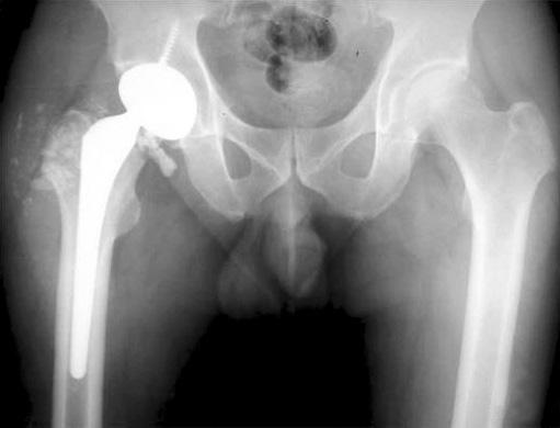 fixed implants with a good position.