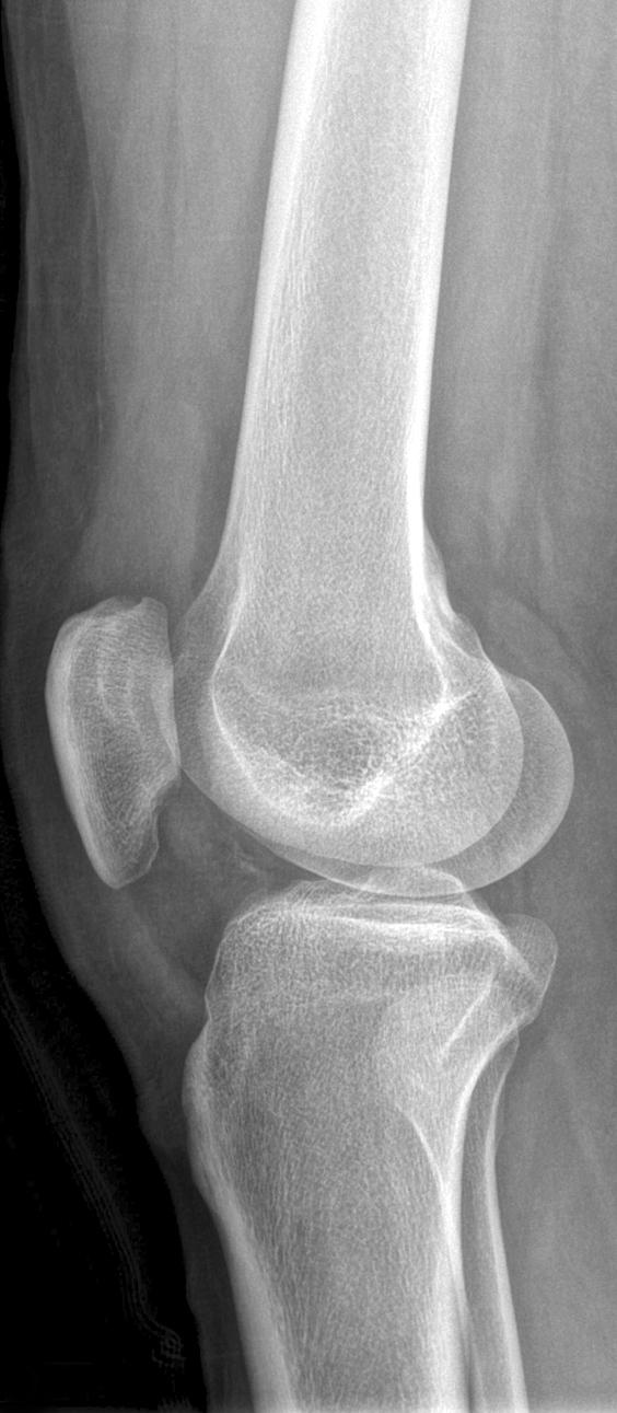 Femoral Attachment Avulsion of ACL with Ipsilateral Femoral Shaft Fracture 201 Fig. 1.