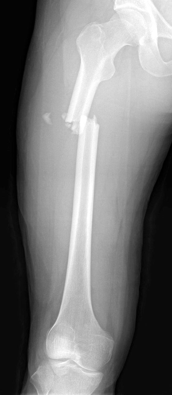 And initial knee anteroposterior (C) and lateral (D) image without a sign of fracture. 간부 골절이 확인되었다(Fig. 1).