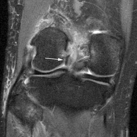 Arthroscopic images show a grossly normal looking anterior cruciate