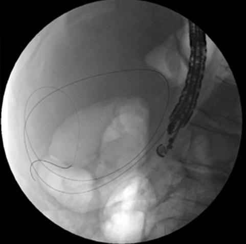 035-inch guidewire is passed into the pseudocyst (endoscopic view). (C) A 0.