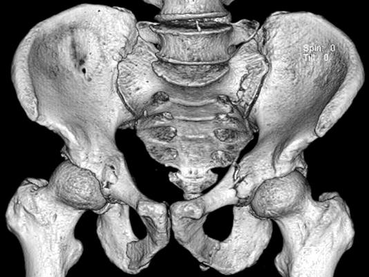 Preoperative pelvis anteroposterior radiograph (A), computed tomography scan axial image (B) and