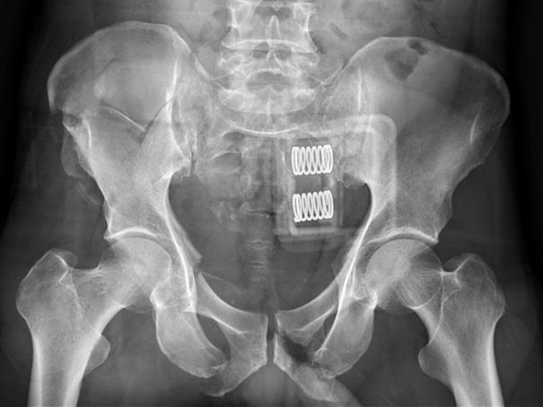 fractures. Postoperative radiograph (D) shows anterior and posterior pelvic ring fixation.