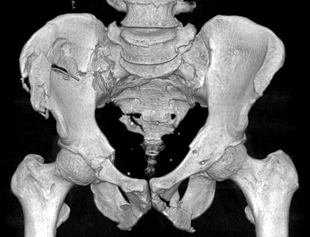 Pennal 분류에 복합손상 (combined mechanism injury, CM) 범주를 더하여 수정하 였으며 손상의 기전을 골절 형태 및 전신 손상과 상호 연 10) 관지어 분석할 수