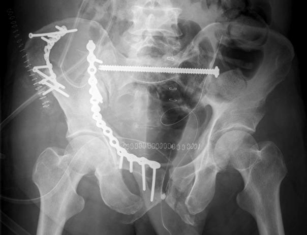 Orthopaedic 13) Trauma Association (OTA) 분류 는 포괄적이며 정보의 수 집 및 보고 목적에 있어 널리 인정되는 표준화된 체계이나 단순히 안정성에만 따른 분류로