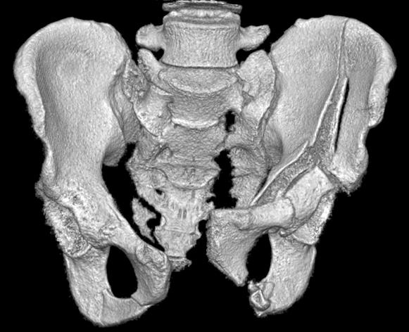 Radiograph two years after operation (D) show healed stable pelvis with anterior and posterior pelvic ring fixation.