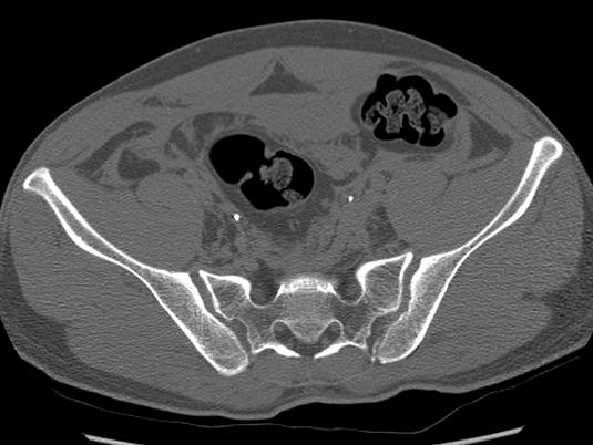 APC: Anteroposterior compression, SI: Sacroiliac. 및 흉부 손상과 연관되어 있으며 이는 측방압박 손상이 전 형적으로 차량에 탑승한 상태에서 측방으로부터의 충격을 받아 발생한다.