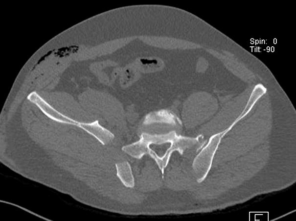 hemipelvis show severe external rotation of the right hemipelvis with SI joint