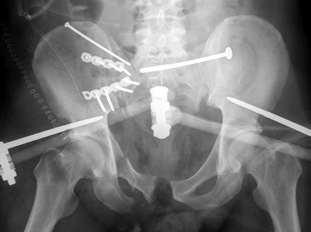 iliosacral screw fixation of the left SI joint with supraacetabular external