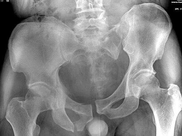 VS type pelvic injury show cephalic displacement of the left hemipelvis with avulsion fracture of the fifth lumbar transverse