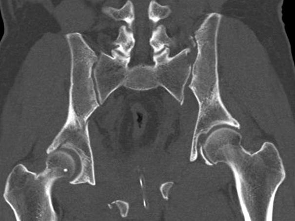 Radiograph of six months after operation (D) shows healed stable pelvis with anterior and posterior pelvic ring fixation.