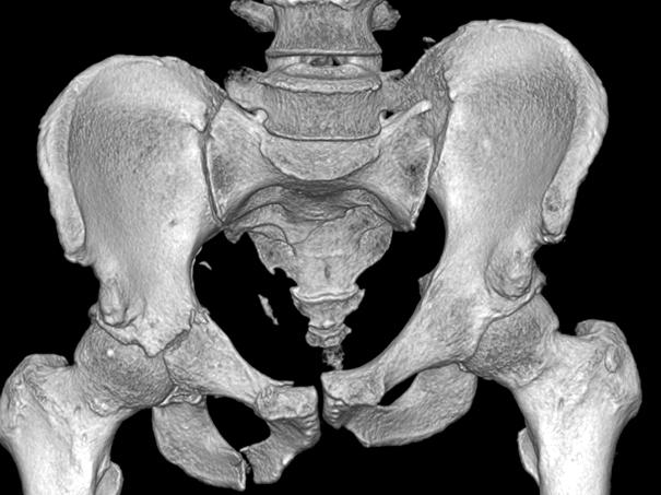 Initial pelvic anteroposterior radiograph (A) of the hemodynamic unstable patient with pelvic belt shows a VS type injury of the