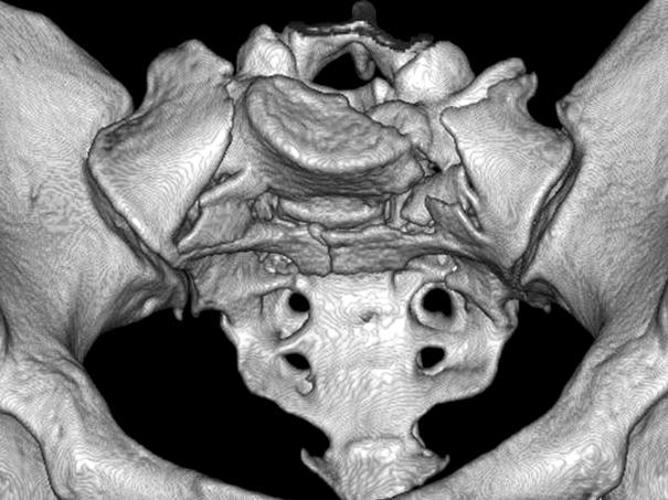 Postoperative radiograph (E) shows rigid lumbopelvic fixation with trans-sacral iliosacral screw fixation. 은신경공에대해내측혹은중앙부의골절이다. 1 형골절은천골신경공의외측으로지나가는수직혹은사선형의골절로서천골골절의약 50% 를차지하며약 6% 정도에서신경증상을야기한다.