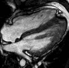 신동맥 CT 소견 : 오른쪽신동맥입구에심한국소적협착소견을보이고있으며, 특징적인염주알형태 (string of beads) 의섬유근육이형성증 (fibromuscular dysplasia) 소견을보이고있지는않았다 (Fig. 3).