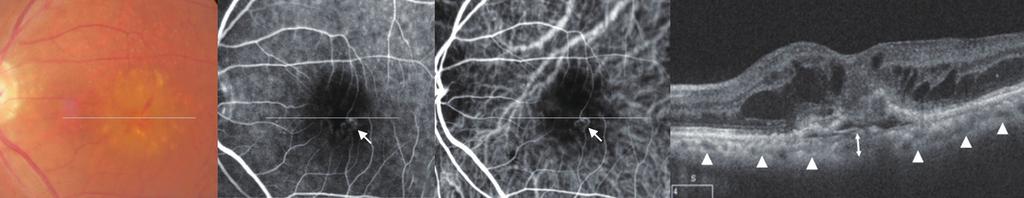 Ahn SE, et al. 망막혈관종성증식치료후맥락막두께 A B C D Figure 1. Representative images of retinal angiomatous proliferation.