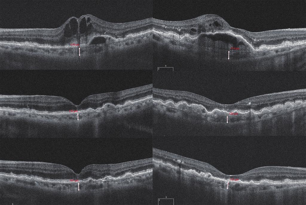 Ahn SE, et al. 망막혈관종성증식 치료 후 맥락막두께 A D B E C F Figure 3. Representative cases of retinal angiomatous proliferation treated with ranibizumab (left column) or aflibercept (right column).