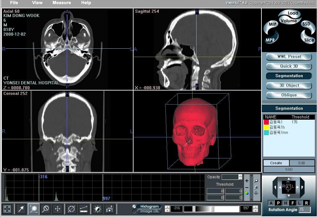 2. 연구방법 가. 3 차원 CT 입체영상 (3D-CT) 제작 3차원적인계측을위하여골격성 Ⅲ급개방교합군의치료시작 (T1) 과수술 1년후에촬영한 3D-CT (T2) 와정상교합군의 3D-CT (N) 에대하여입체영상을제작하였다.