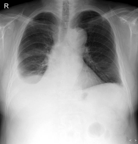 Tuberculosis and Respiratory Diseases Vol. 64. No. 3, Mar. 2008 중이었다. 가족력 : 특이소견없었다. 약물복용력 : Hydroxyurea 500 1,500 mg (2005.9.14 2007.7.31) 과 2005년부터고혈압으로 amlodipine 복용중이었다.