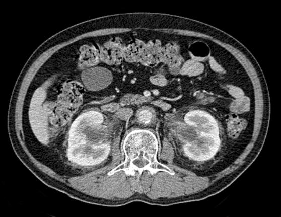 Chest X-ray shows right-sided pleural effusion. 부이학적검사에서오른쪽폐하부의호흡음감소되었으며수포음및흉막마찰음은청진되지않았다. 복부진찰소견상특이소견은없었고양상지와하지에압박통은없었다. 신경학적검사상특이소견은없었다. 검사실결과 : 말초혈액검사에서백혈구 9,060/mm 3 ( 중성구 76%, 림프구 14%, 단핵구 6.