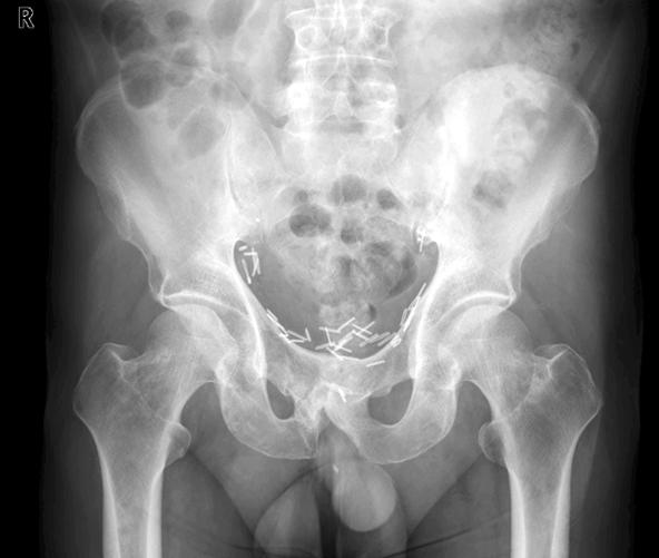 (B) Right humerus AP X-ray also shows diffuse sclerosis in proximal humeral shaft. Figure 4.