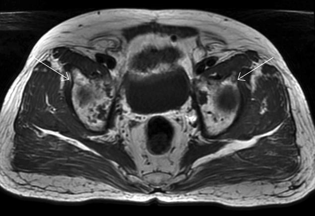 signal changes (arrow) involving the L4-5 body and other multiple lesions in pelvic bone.