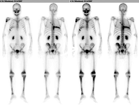 Tuberculosis and Respiratory Diseases Vol. 64. No. 3, Mar. 2008 구혈률은 60%, 심낭유출액이전벽 0.5 cm, 후벽 0.9 cm으로측정되었으며이외다른심벽운동의이상소견은보이지않았다. 약 1주후호흡곤란과사지동통으로재입원했다.