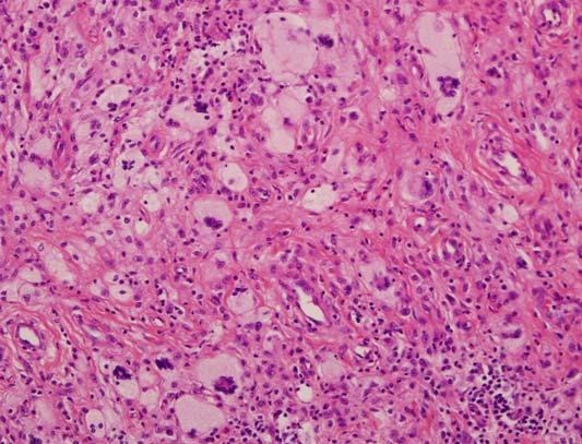 Pleural biopsy, (A) there are diffuse lipid-laden histiocyte infiltration, and Touton-type multinucleated eosinophilic giant cell (arrow) (H&E stain, 200).