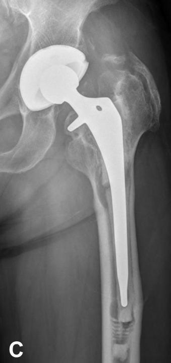 loosening of femoral component with findings