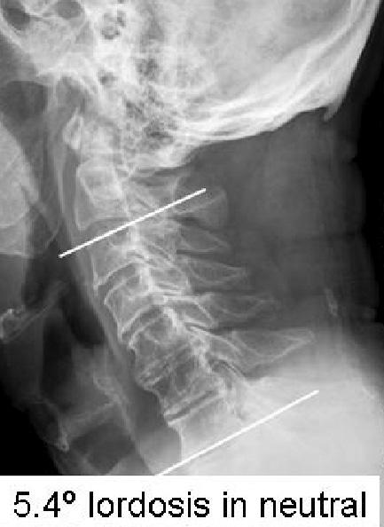 Preoperative cervical spine lateral radiographs show 5.